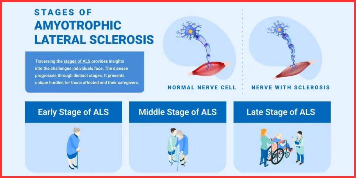 showing the image of Top 10 ALS Research Breakthroughs , ALS stages